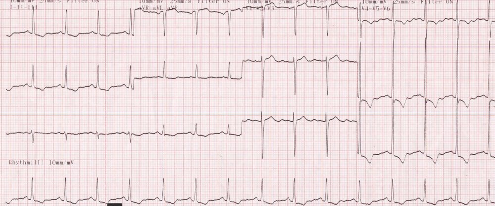 Left Ventricular Strain Pattern - Pattern.rjuuc.edu.np