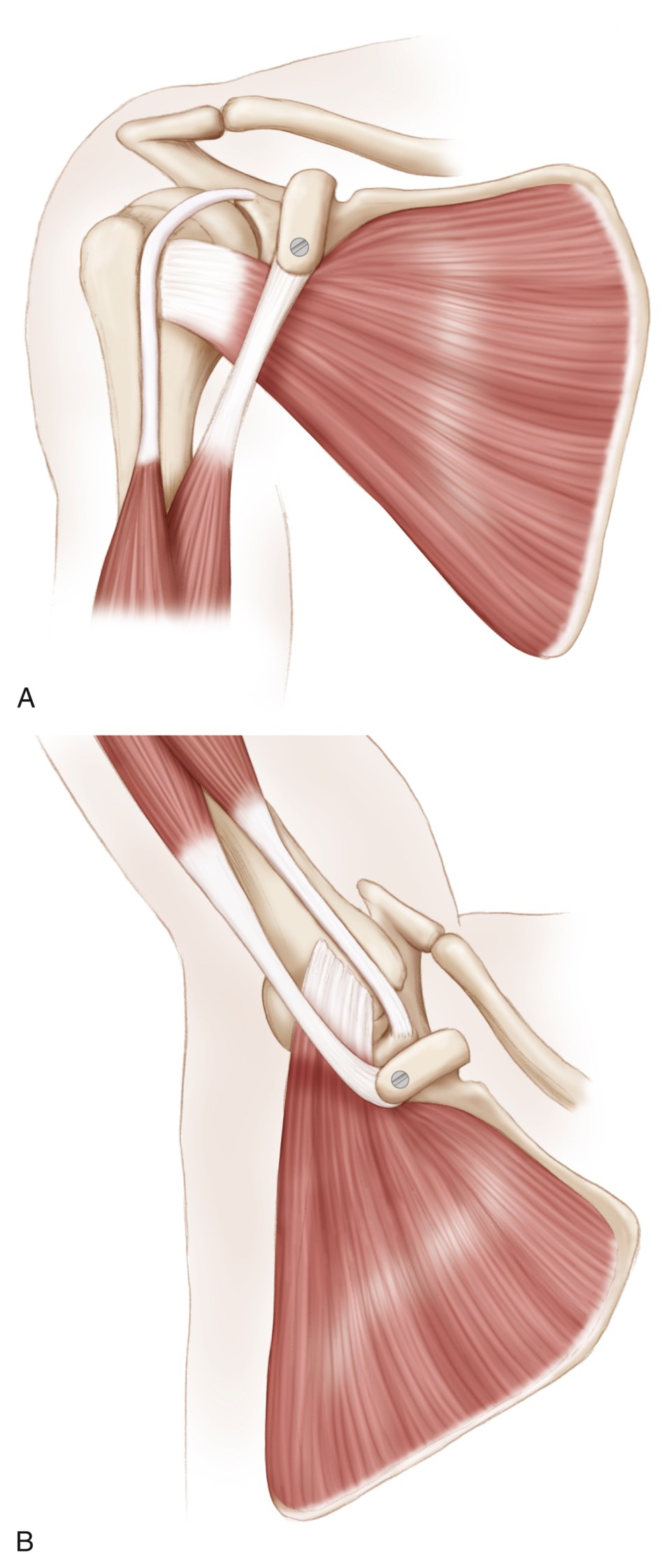 Conjoint Tendon Shoulder Anatomy / Conjoint Tendon Foto De Medico ...