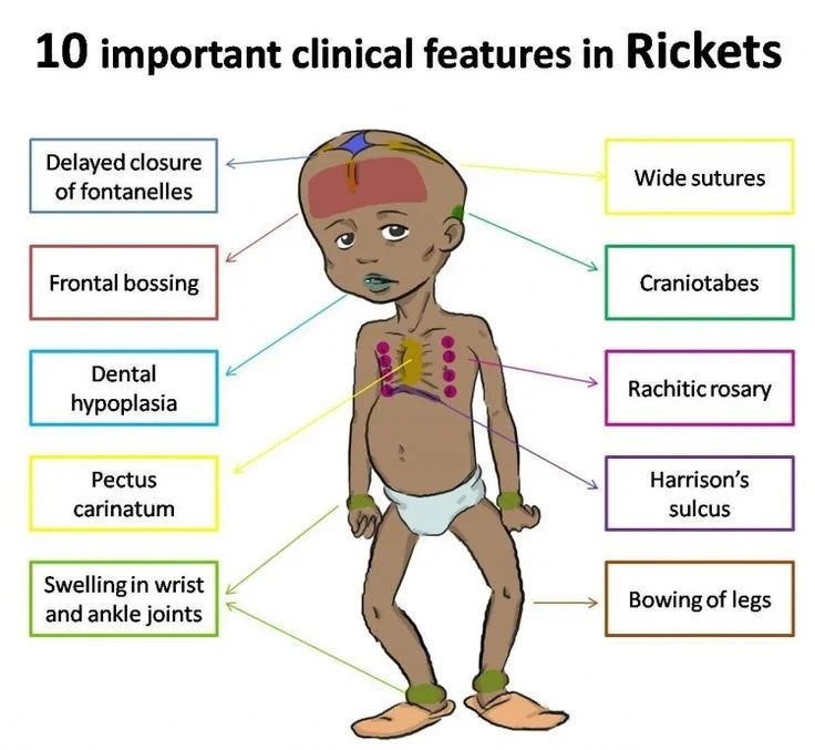 Rickets Symptoms