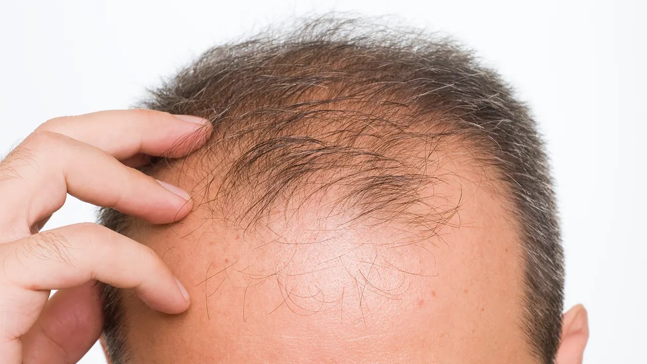 Hair loss may be a coronavirus symptom, study finds Fox News