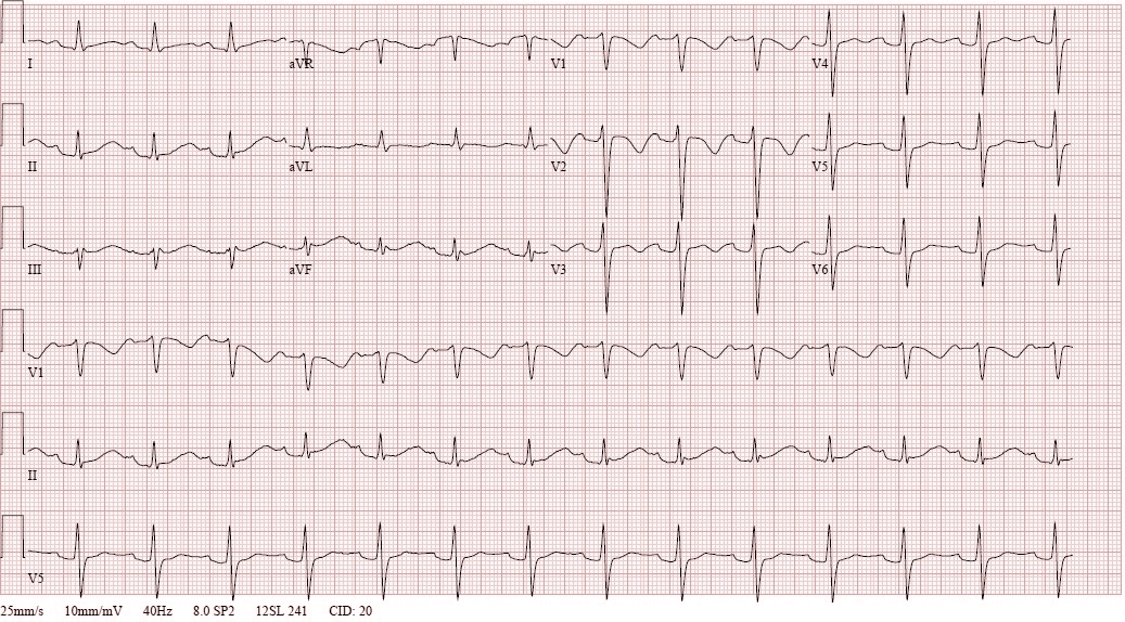 ACMT Toxicology Visual Pearls: Drug-Induced QT Prolongation