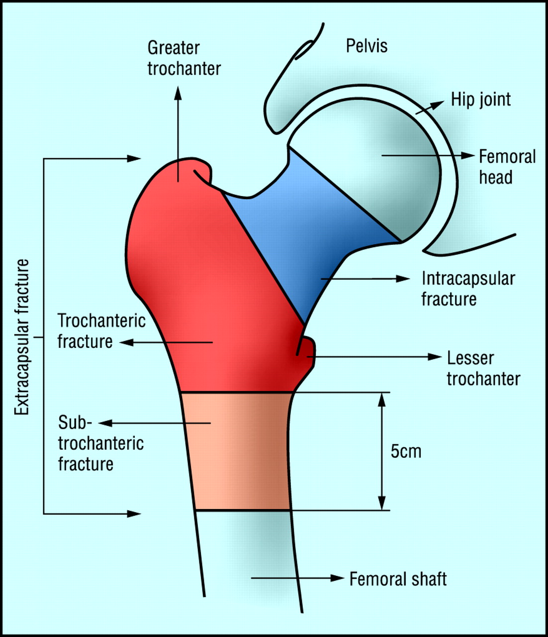 Types Of Hip Injuries