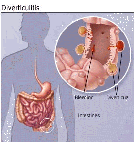 Predilection Pics: Diverticulitis Pictures