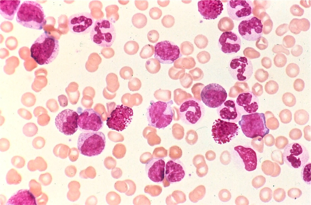 How to tell apart leukemias and lymphomas Pathology Student