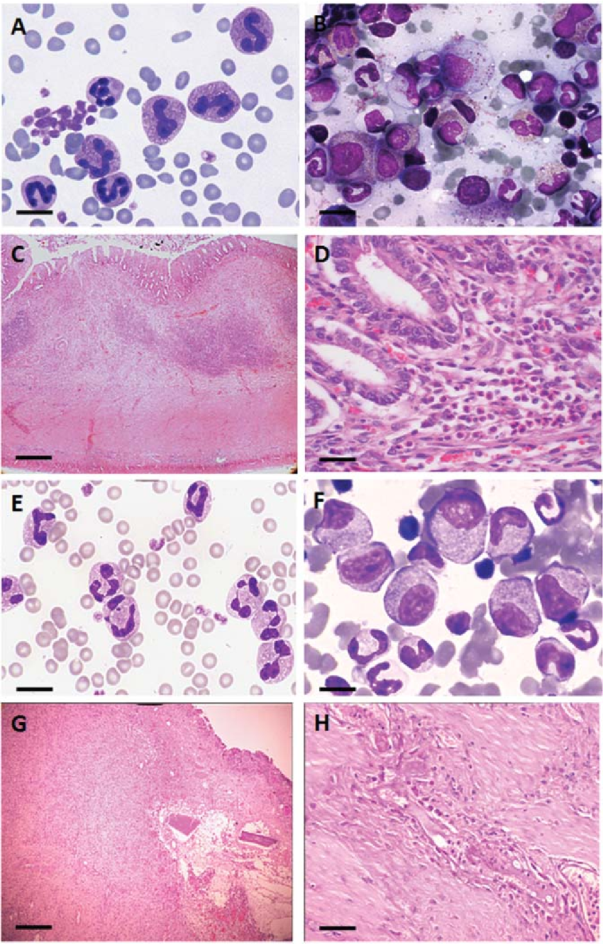 Cytological findings of the peripheral blood and bone marrow smear and