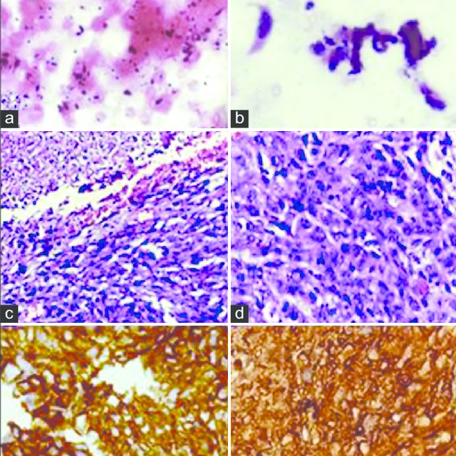 Histopathology (a and b) Cytology smear of cutaneous lesion showing