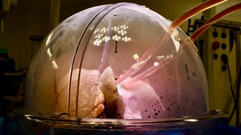 Donated lungs inside a special dome shaped incubator. The dome is plastic and you can see the tubes carrying liquid oxygen and nitrates going into the trachea of the lungs. They are being inflated by a ventilator