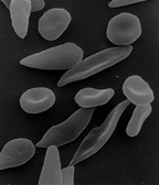 Sickle cells