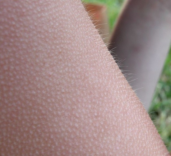 Goose Bumps