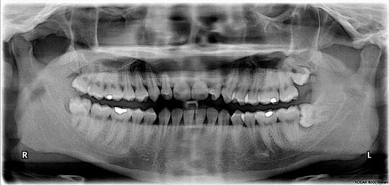 Impacted wisdom teeth