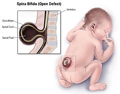 Spina Bifida