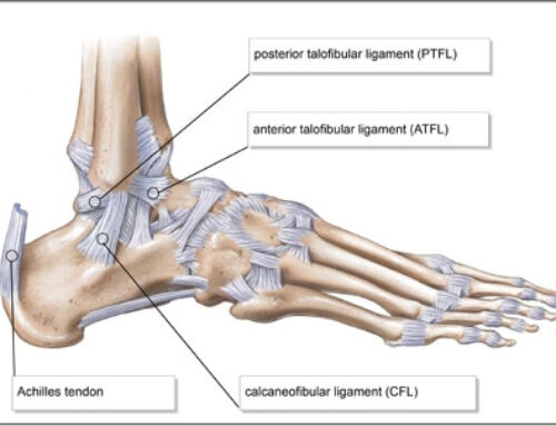 Anterior Talofibula Ligament (ATFL) Tear