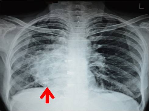 Scimitar Syndrome in an Adult: Case Report and Review | International ...