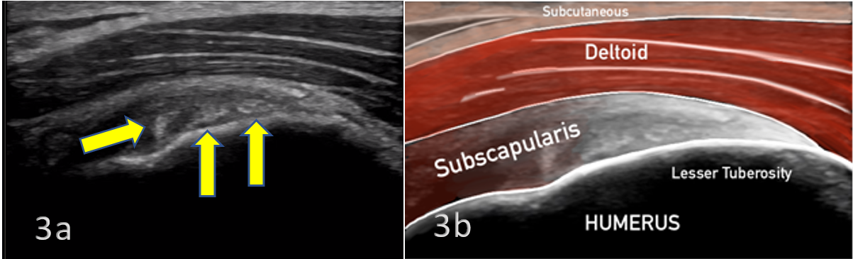 Subscapularis Muscle Tear