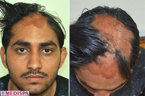 Share 79+ hair transplant scalp best - in.eteachers