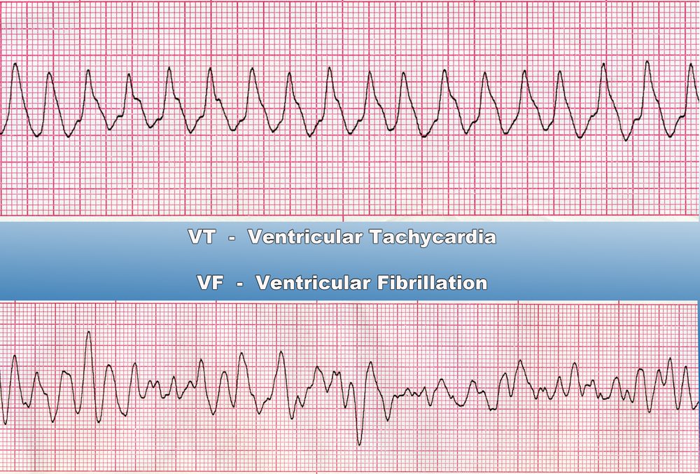 Ventriculaire Tachycardie Symptomen Oorzaken Diagnose Behandeling ...