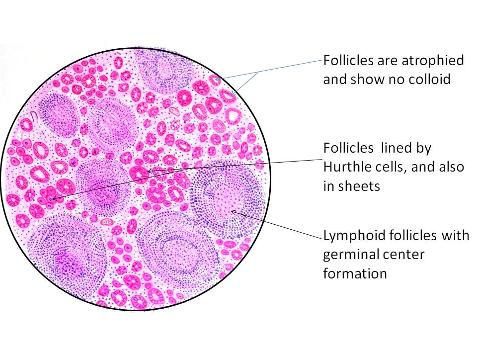 Hashimotos Thyroiditis