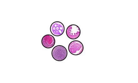 Ductal & Lobular Carcinoma in Situ- Breast