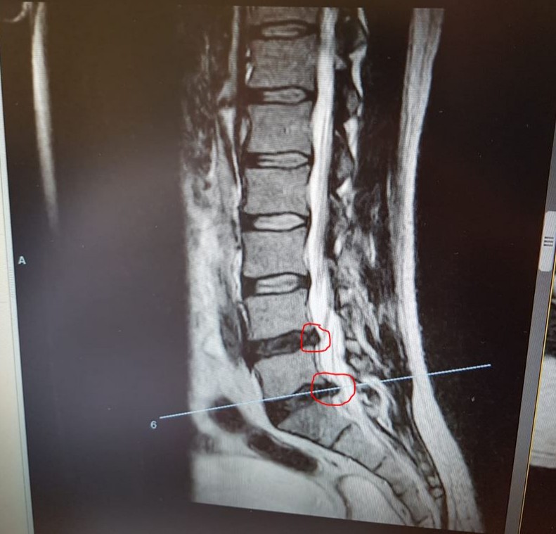 Bulging Disc in back S1-L5 Sciatica - Singletrack World Magazine ...