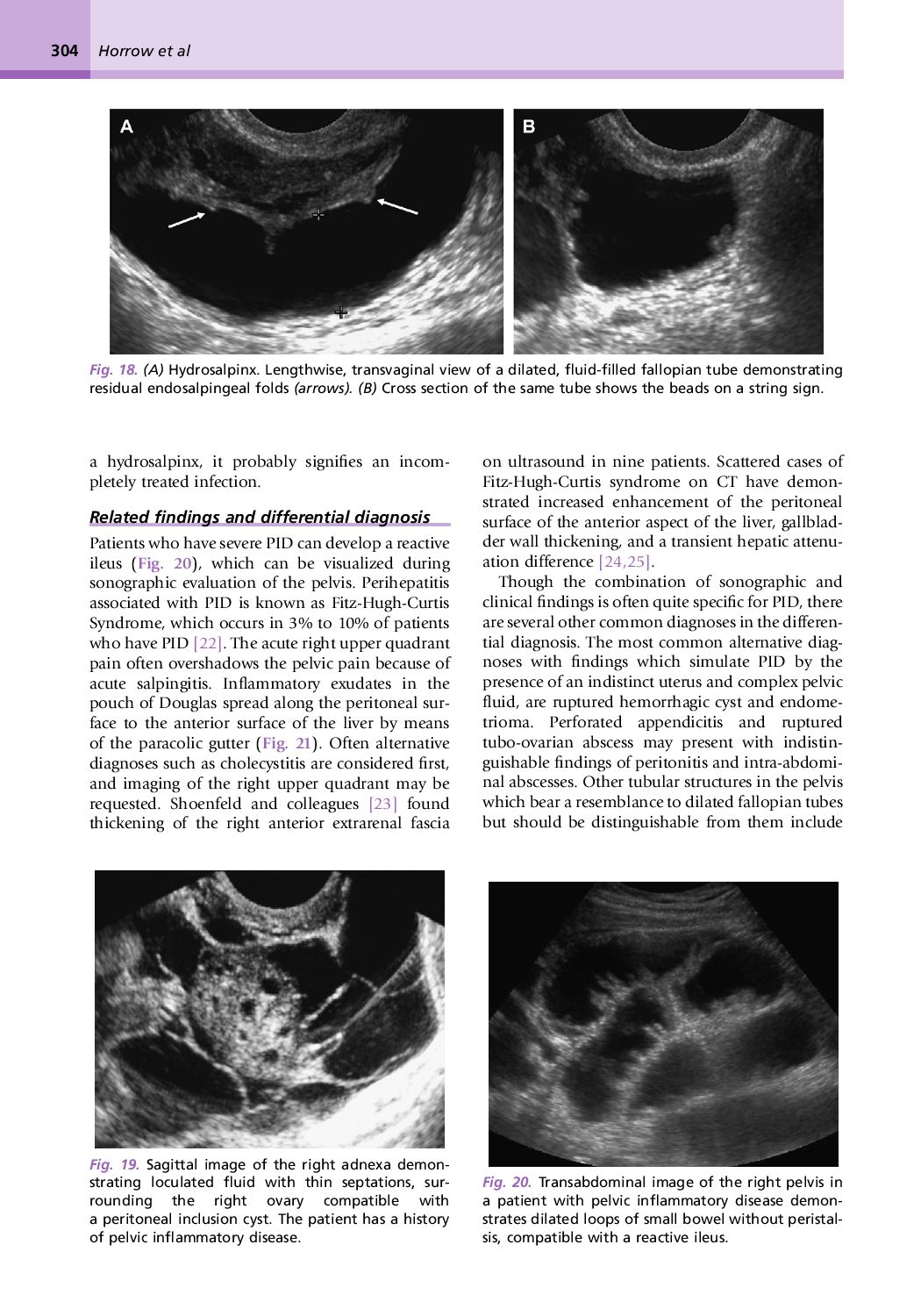 Overview Of Pelvic Inflammatory Disease Synappsehealt - vrogue.co