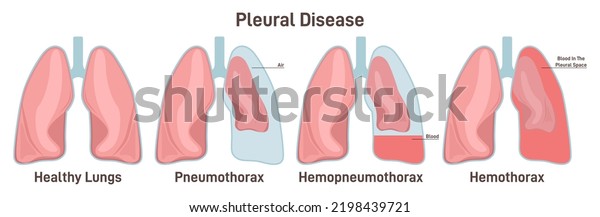 Pleural Effusions Abnormal Gathering Blood Air Stock Vector (Royalty ...