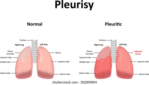 늑막염 Images, Stock Photos & Vectors | Shutterstock