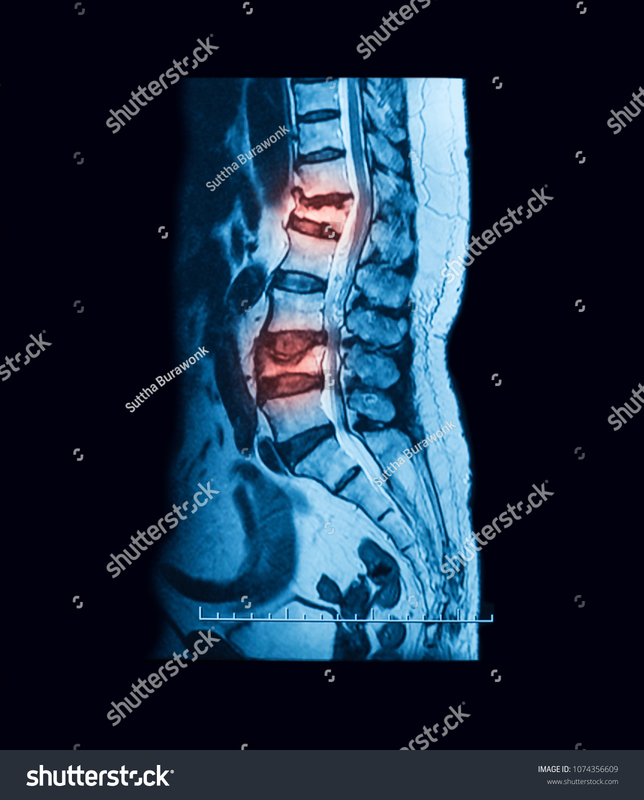 Mri Scan Lumbosacral Ls Spine Case Stock Photo 1074356609 | Shutterstock