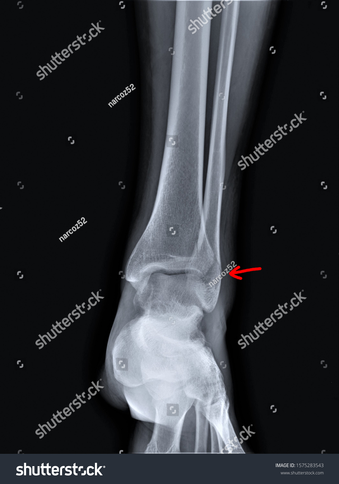 Radiograph Ankle Joint Fracture Outer Ankle Stock Photo 1575283543 ...