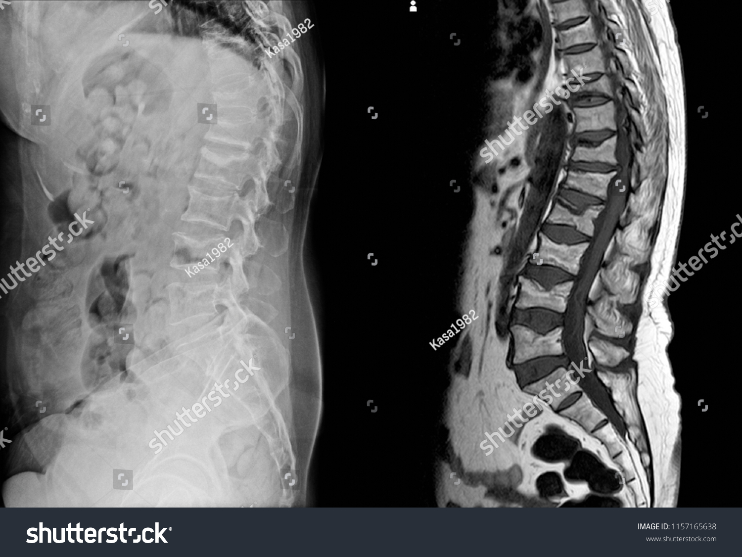 X-ray and MRI Lumbar spine findings severe - Royalty Free Stock Photo ...