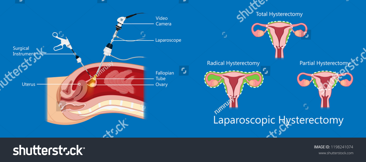 laparoscopic hysterectomy medical surgical treat - Royalty Free Stock ...