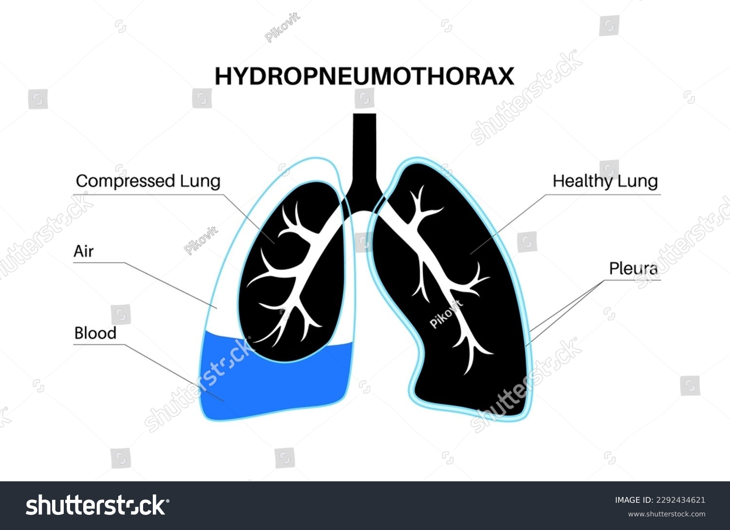 Hemopneumothorax lungs disease. Combination of - Royalty Free Stock ...