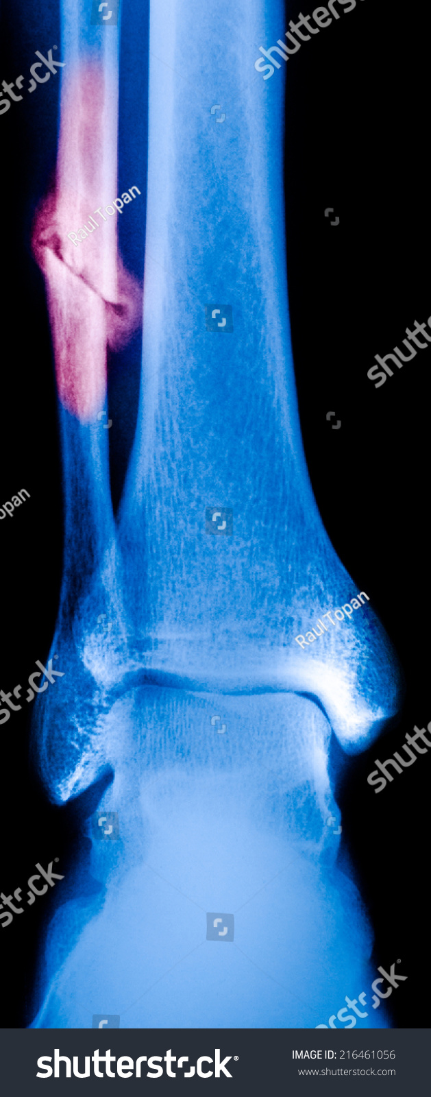 Fibula Fracture - Weber C Stock Photo 216461056 : Shutterstock