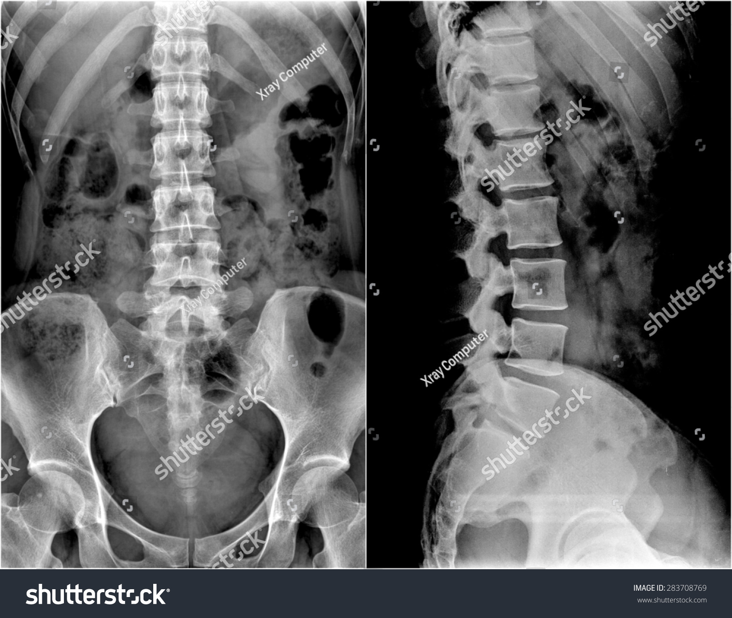 Spine Pelvis Human Body On Xray Stock Photo 283708769 | Shutterstock