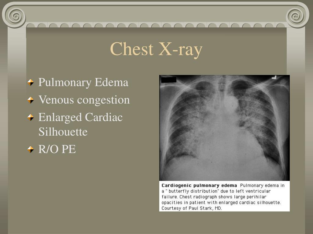 PPT - Peripartum Cardiomyopathy PowerPoint Presentation, free download ...