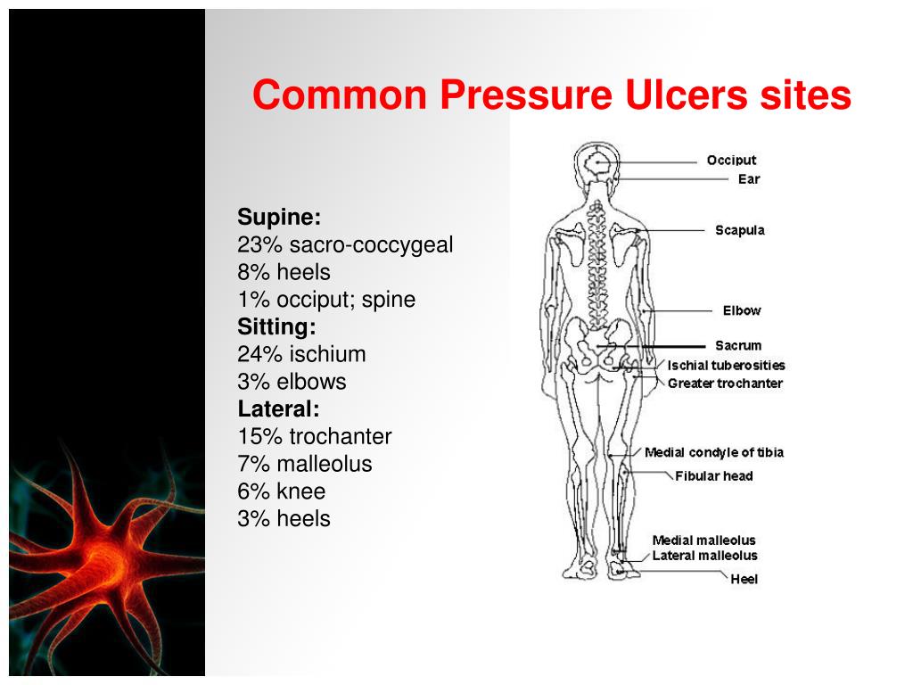 PPT - Pressure Ulcers Assessment and Management PowerPoint Presentation ...