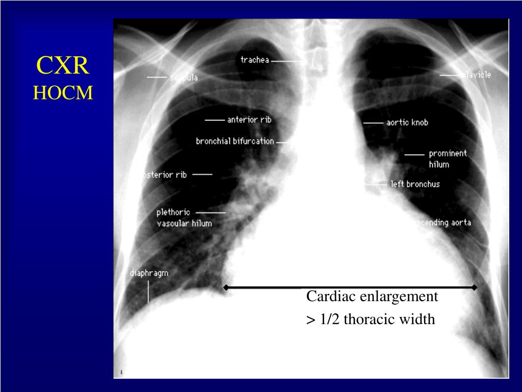 PPT - Hypertrophic Obstructive Cardiomyopathy (Case Presentation ...