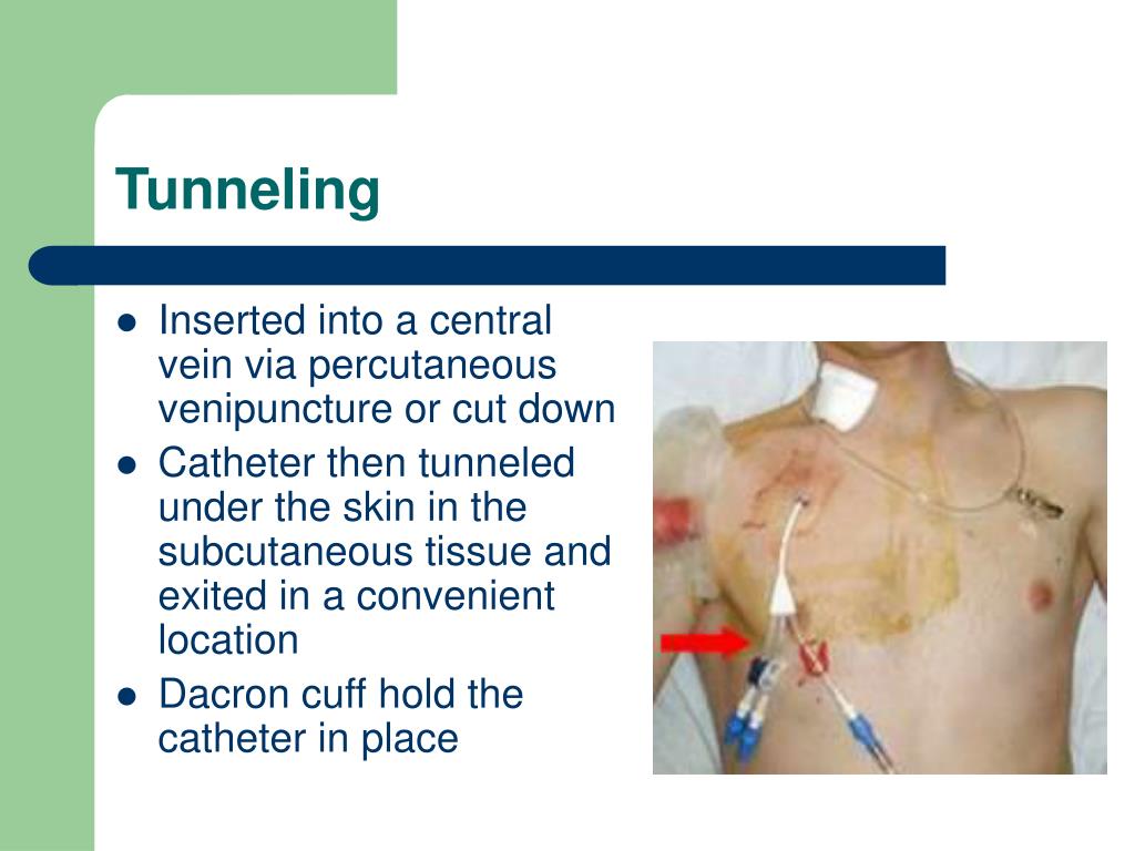 Different Types Of Tunneled Catheters at Crystal McBride blog