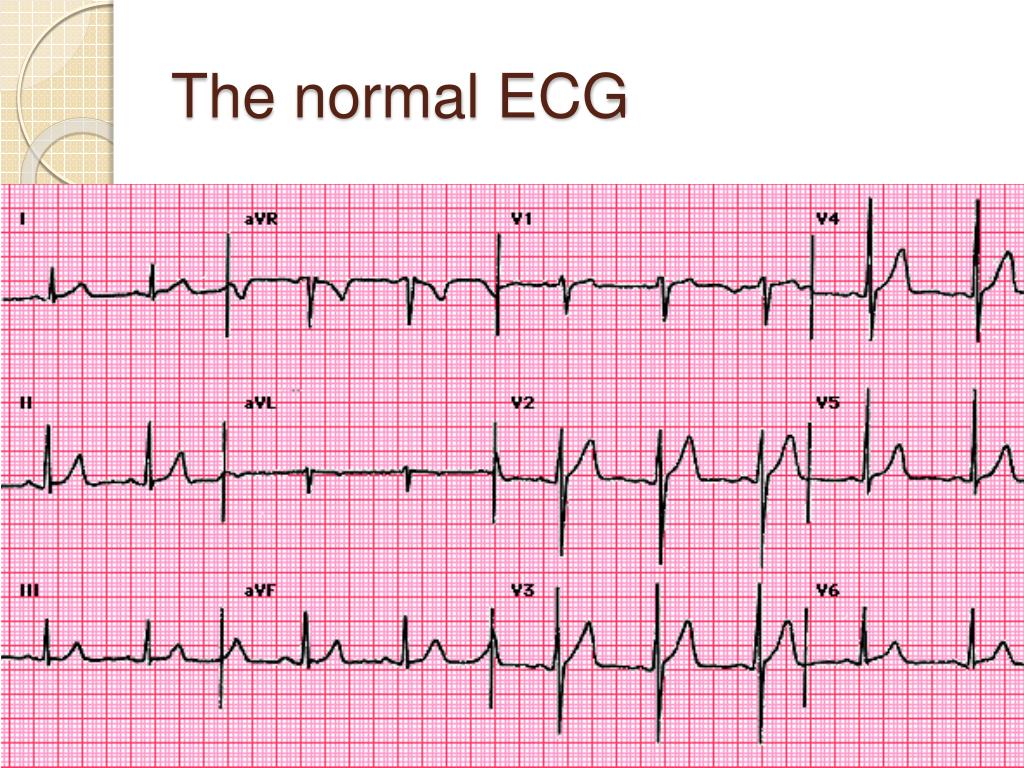 Ekg Examples - Rezfoods - Resep Masakan Indonesia