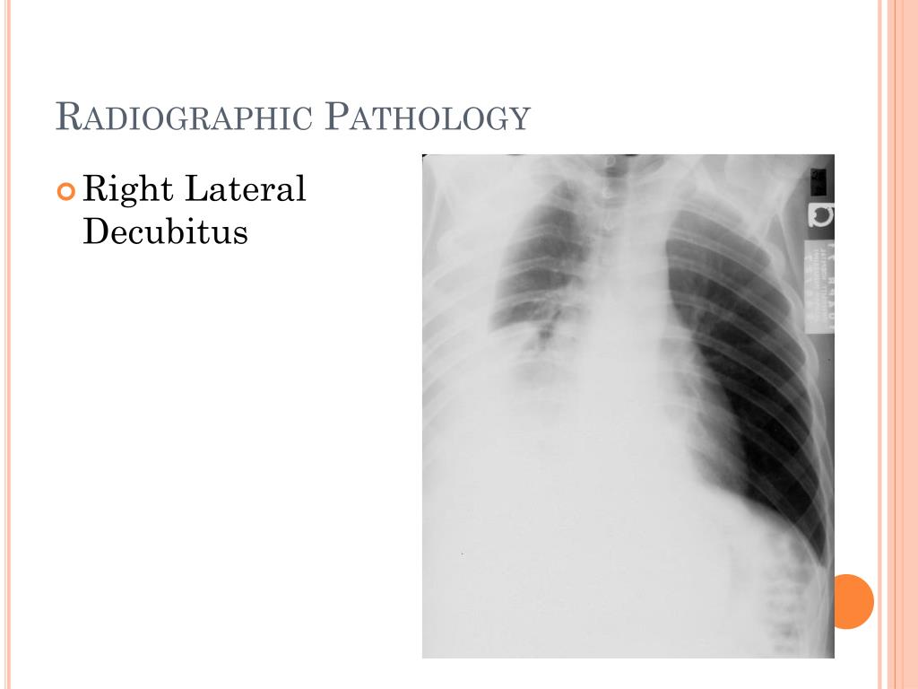 PPT - CXR review PowerPoint Presentation, free download - ID:464249