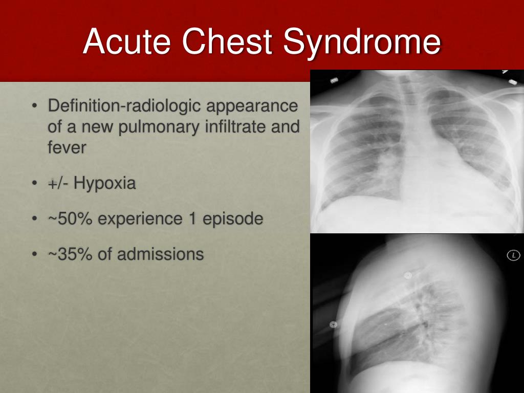 PPT - Sickle Cell Disease Part I & II PowerPoint Presentation, free ... image.