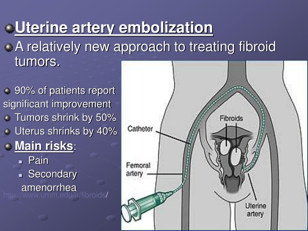 Uterine Artery Embolization Explained By Dr Lalezaria - vrogue.co