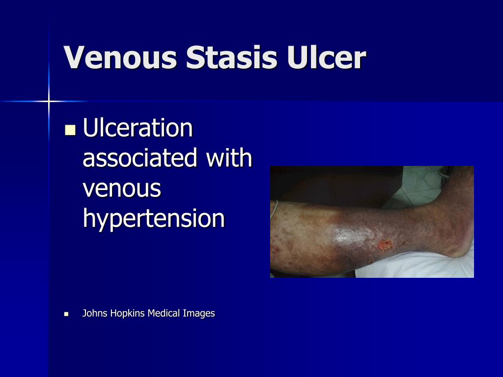 Ppt Venous Stasis Management And Ulcer Healing Powerpoint | My XXX Hot Girl