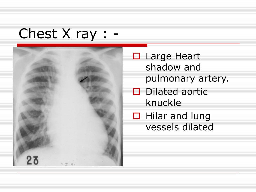 PPT - Congenital heart disease (CHD) PowerPoint Presentation, free ...