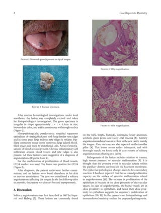 2 Case Reports in Dentistry
Figure 1: Brownish growth present on tip of tongue.
Figure 2: Excised specimen.
After routine hematological investigations, under local
anesthesia, the lesion was completely excised and taken
for histopathological investigation. The gross specimen is
irregular in shape approximately 1 × 1 × 0.5 cm in size,
brownish in color, and soft in consistency with rough surface
(Figure 2).
Histopathologically, parakeratotic stratified squamous
epithelium of varying thickness with long slender rete ridges
and in some areas large bulbous rete ridges is evident. Pap-
illary connective tissue shows numerous large dilated blood-
filled spaces and lined by endothelial cells. Areas of extrava-
sations of blood are also present. Chronic inflammatory cell
infiltration around blood vessels and rete ridges is also
present. All these features were suggestive of a diagnosis of
angiokeratoma (Figures 3 and 4).
For the confirmation of proliferation of blood vessels,
CD34 marker was used. The lesion was positive for CD34
(Figure 5).
After diagnosis, the patient underwent further exami-
nations, and no lesions were found elsewhere in his skin
or mucous membranes. The case was considered a solitary
angiokeratoma affecting the tongue. In the last followup after
six months, the patient was disease-free and asymptomatic.
3. Discussion
Solitary angiokeratoma was first described in 1967 by Impe-
rial and Helwig [7]. These lesions are commonly found
Figure 3: 100x magnification.
Figure 4: 400x magnification.
on the hips, thighs, buttocks, umbilicus, lower abdomen,
scrotum, glans penis, and rarely oral mucosa [8]. Solitary
angiokeratomas have been described in the oral cavity, mainly
the tongue. Also, one case was also reported on the tonsillar
pillar [9]. This lesion seems rather infrequent, and with
thorough search, we found only 16 case reports of solitary
angiokeratomas affecting oral cavity.
Pathogenesis of the lesion includes relation to trauma,
high venous pressure, or vascular malformation [3]. It is
thought that the primary event is vascular ectasia within
the papillary dermis just beneath the basement membrane.
The epidermal pathological changes seem to be a secondary
reaction. It has been reported that the increased proliferative
capacity on the surface of vascular malformation related
to angiokeratoma [10]. The increase in proliferation of the
epithelium is because of the close proximity of the vascular
spaces. In case of angiokeratoma, the blood vessels are in
close proximity to epithelium, and hence their close prox-
imity to epithelium suggests the secondary proliferation of
epithelium [10, 11]. In the present case, histopathology and
immunohistochemistry confirm the proposed pathogenesis.
 