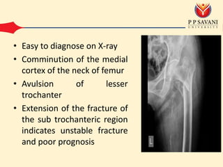 • Easy to diagnose on X-ray
• Comminution of the medial
cortex of the neck of femur
• Avulsion of lesser
trochanter
• Extension of the fracture of
the sub trochanteric region
indicates unstable fracture
and poor prognosis
 