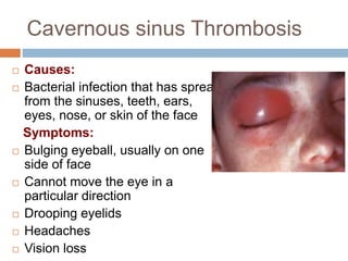 Cavernous sinus Thrombosis
 Causes:
 Bacterial infection that has spread
from the sinuses, teeth, ears,
eyes, nose, or skin of the face
Symptoms:
 Bulging eyeball, usually on one
side of face
 Cannot move the eye in a
particular direction
 Drooping eyelids
 Headaches
 Vision loss
 