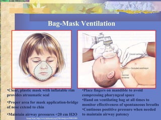 Bag-Mask Ventilation Clear, plastic mask with inflatable rim provides atraumatic seal Proper area for mask application-bridge of nose extend to chin Maintain airway pressures <20 cm H2O Place fingers on mandible to avoid compressing pharyngeal space Hand on ventilating bag at all times to monitor effectiveness of spontaneous breaths Continous postitive pressure when needed to maintain airway patency Image from: http://www.hadassah.org.il/NR/rdonlyres/59B531BD-EECC-4FOE-9E81-14B9B29D139B1945/AirwayManagement.ppt 