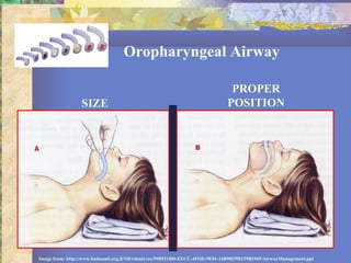 Oropharyngeal Airway SIZE PROPER POSITION Image from: http://www.hadassah.org.il/NR/rdonlyres/59B531BD-EECC-4FOE-9E81-14B9B29D139B1945/AirwayManagement.ppt 