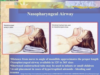 Nasopharyngeal Airway Distance from nares to angle of mandible approximates the proper length Nasopharyngeal airway available in 12F to 36F sizes Shortened endotracheal tube may be used in infants or small children Avoid placement in cases of hypertrophied adenoids - bleeding and trauma Image from: http://www.hadassah.org.il/NR/rdonlyres/59B531BD-EECC-4FOE-9E81-14B9B29D139B1945/AirwayManagement.ppt 