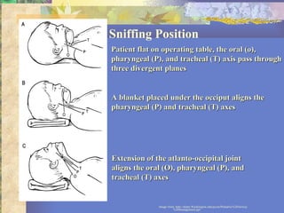 Sniffing Position Image from: http://depts.Washington.edu/pccm/Pediatric%20Airway%20management.ppt Patient flat on operating table, the oral (o), pharyngeal (P), and tracheal (T) axis pass through three divergent planes A blanket placed under the occiput aligns the pharyngeal (P) and tracheal (T) axes Extension of the atlanto-occipital joint aligns the oral (O), pharyngeal (P), and tracheal (T) axes 